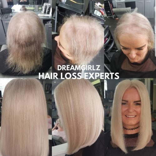 Hair Loss - Dreamgirlz Hair Extensions =
